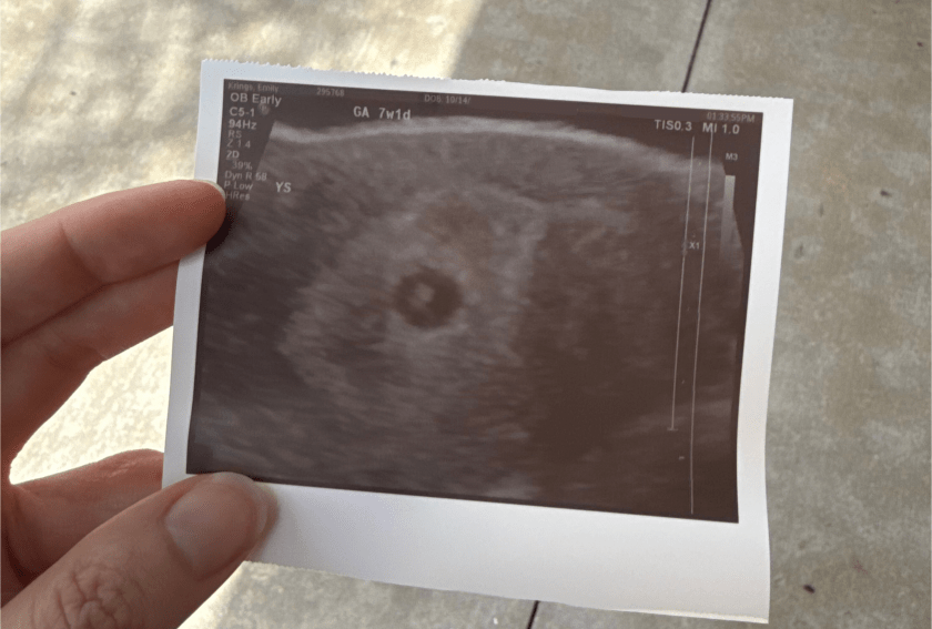 Ultrasound at 7 weeks